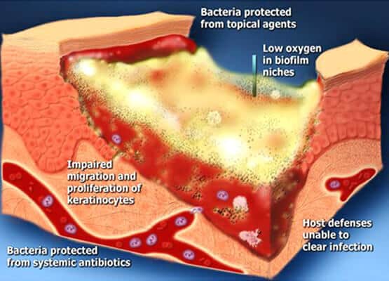 Bacterial biofilm results